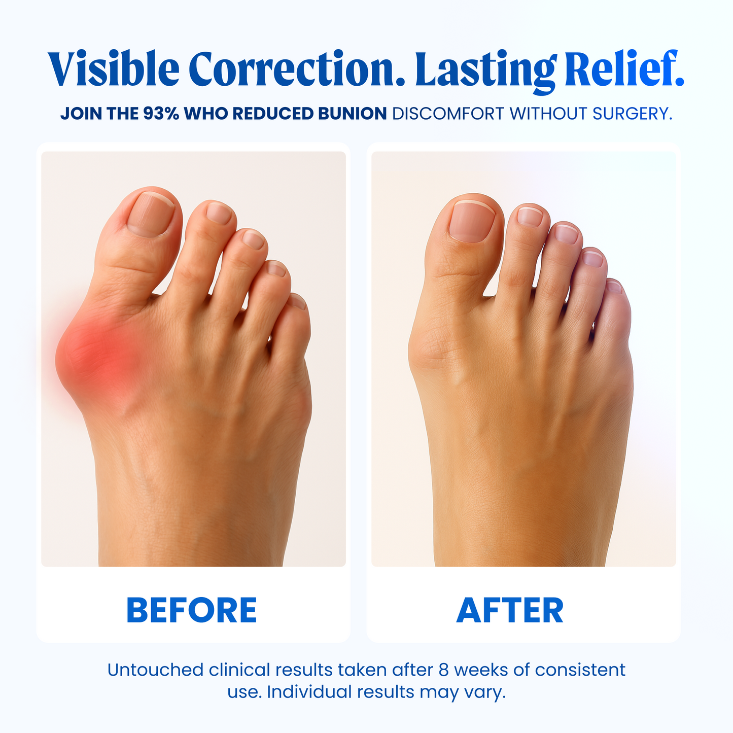 AlignRight™ Bunion Corrector