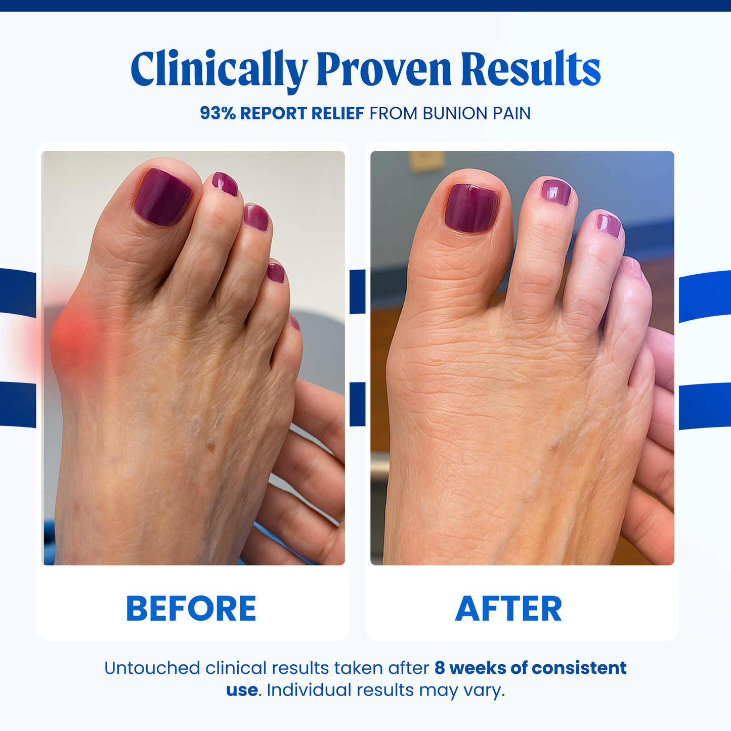AlignRight™ Bunion Corrector